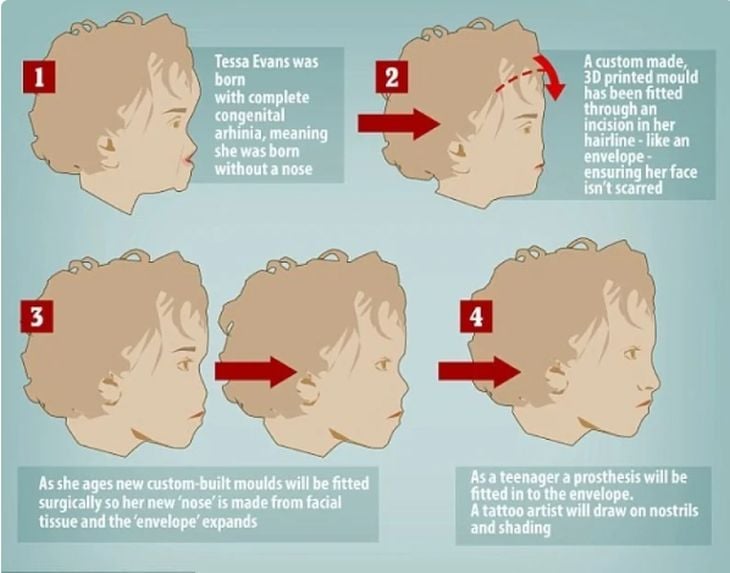 Бебе се роди без нос, няма да повярвате как изглежда сега