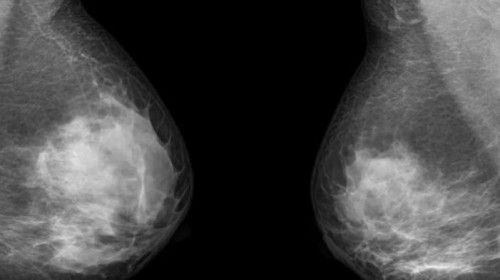 снимка на рак на гърдата