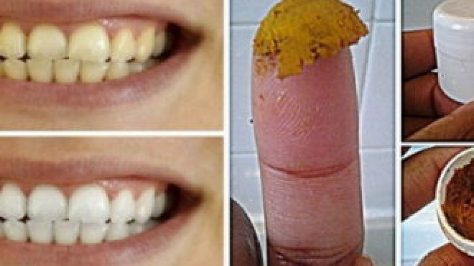 Стоматолозите мълчат за тази естествена паста за зъби, с която ще забравите за кариесите и проблемите с венците