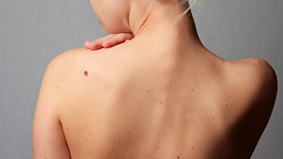 Всеки човек трябва да знае тези 6 неща за рака на кожата, ако иска да се спаси!