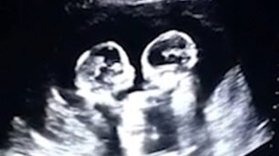 Близначки станаха хит в мрежата още преди раждането си заради това ВИДЕО