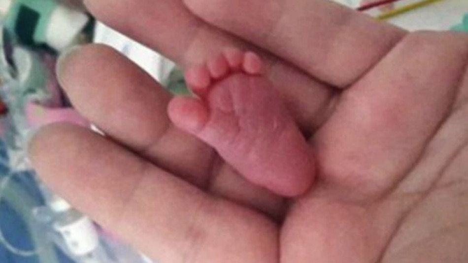 Чудото с малкия борец Емилия, която се роди едва 226 грама, удиви и лекарите СНИМКИ