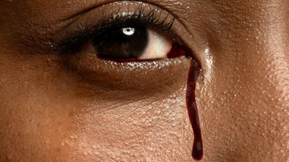 Кръв вместо сълзи потече от очите на момиче, причината шокира