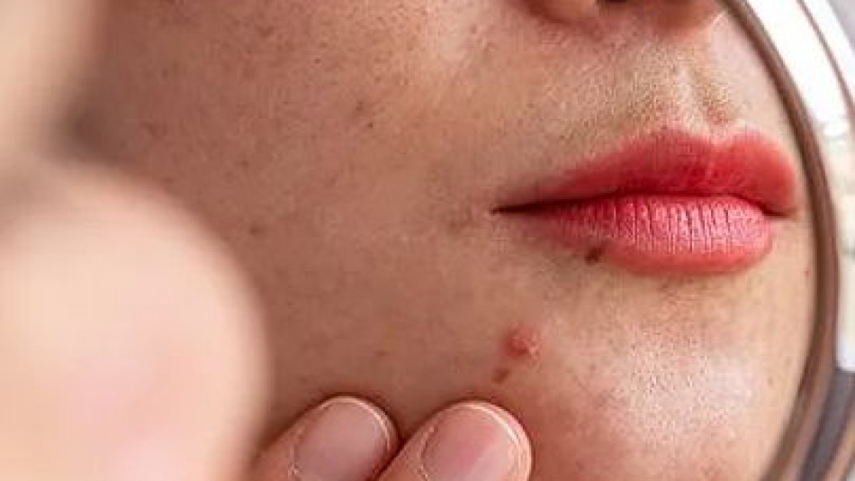 Акне и мазна кожа: Тези храни съсипват лицето ви